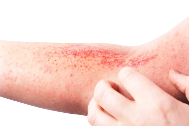 Atopic Skin and Senses
