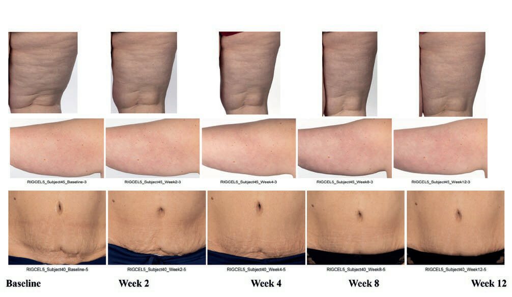 EURO COSMETICS Magazine • Clinical improvement of appearance of cellulite and skin characteristics with a non-invasive biphasic pulsed microcurrent device system • Melanie Riggs, K.C. Holley, Helen Knaggs1, Steve Powell, Brian Cook, Ganesh Diwakar • Melanie Riggs, K.C. Holley, Helen Knaggs1, Steve Powell, Brian Cook, Ganesh Diwakar