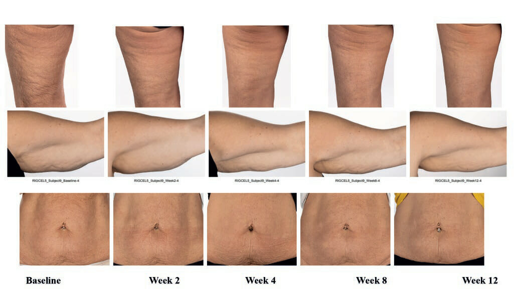 EURO COSMETICS Magazine • Clinical improvement of appearance of cellulite and skin characteristics with a non-invasive biphasic pulsed microcurrent device system • Melanie Riggs, K.C. Holley, Helen Knaggs1, Steve Powell, Brian Cook, Ganesh Diwakar • Melanie Riggs, K.C. Holley, Helen Knaggs1, Steve Powell, Brian Cook, Ganesh Diwakar