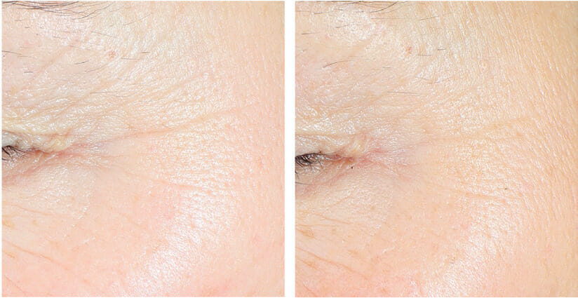 EURO COSMETICS Magazine • The Use of Submicron Lipid Matrix-Encapsulated Actives Offers a Multitude of Advantages for the Overall Performance of Skin Care Formulations • Dr. Sabilla Digel • Dr. Sabilla Digel