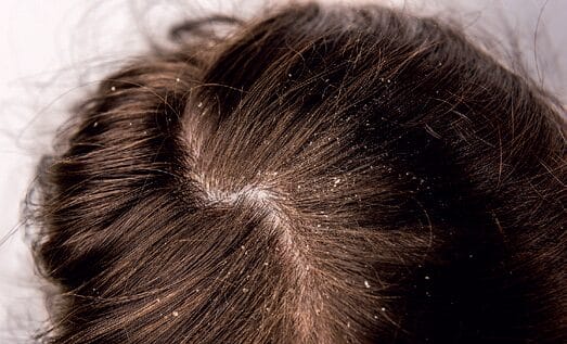 EURO COSMETICS Magazine • Exploring the Relationship Between the Scalp Microbiome and Dandruff • Charlotte Vedel • Charlotte Vedel
